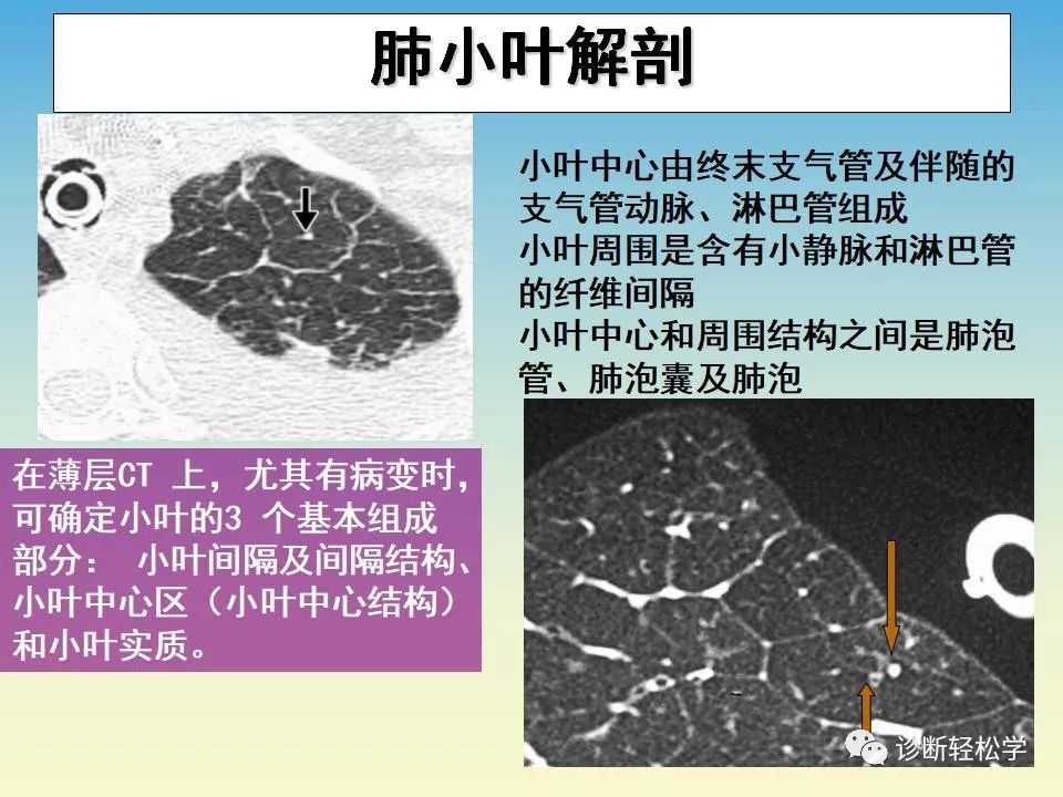 影像PPT - 【PPT】肺间质纤维化的影像表现-3
