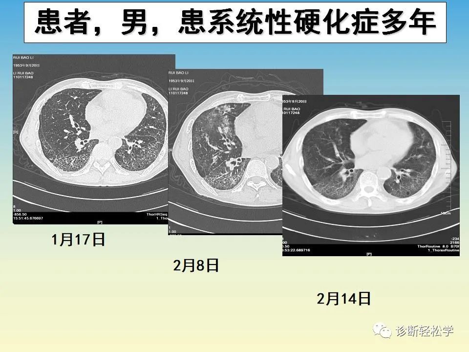 影像PPT - 【PPT】肺间质纤维化的影像表现-7