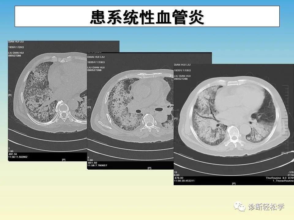 影像PPT - 【PPT】肺间质纤维化的影像表现-8