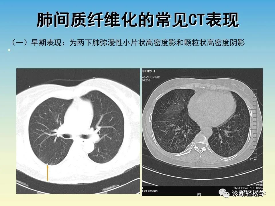 影像PPT - 【PPT】肺间质纤维化的影像表现-10