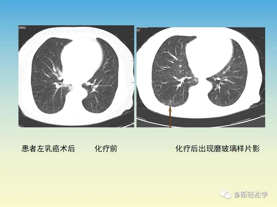 影像PPT - 【PPT】肺间质纤维化的影像表现-11