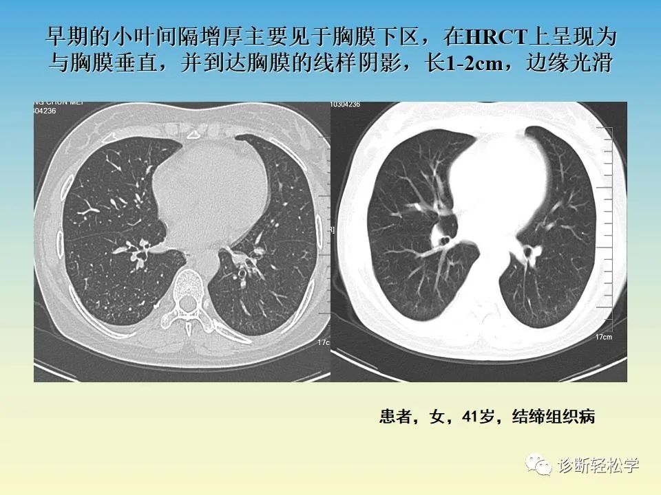 影像PPT - 【PPT】肺间质纤维化的影像表现-13
