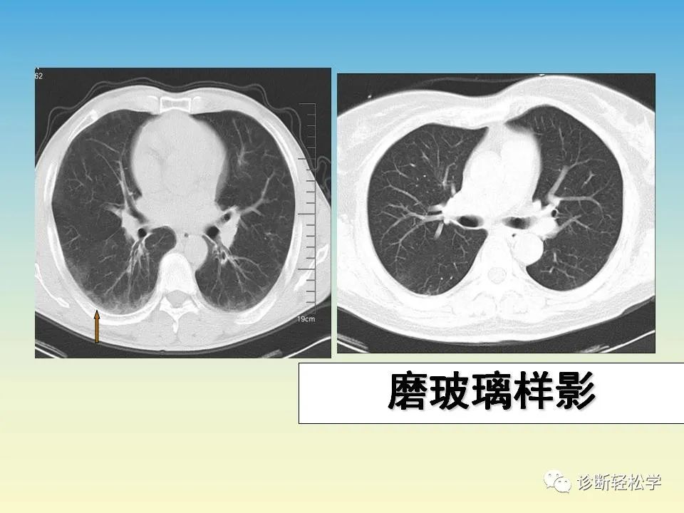 影像PPT - 【PPT】肺间质纤维化的影像表现-12