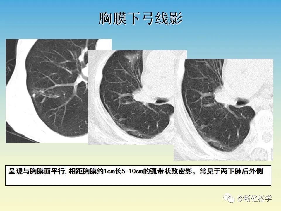 影像PPT - 【PPT】肺间质纤维化的影像表现-18
