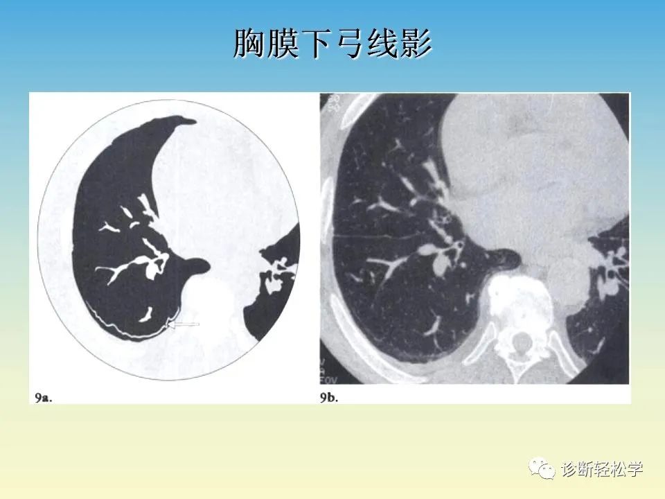 影像PPT - 【PPT】肺间质纤维化的影像表现-17