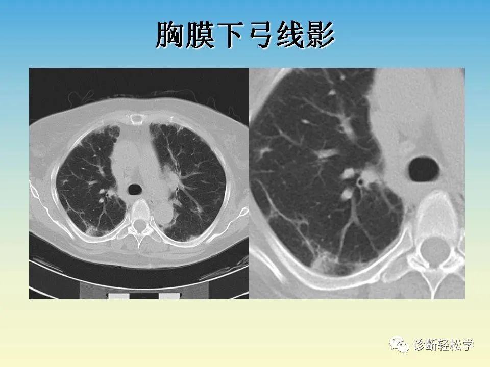 影像PPT - 【PPT】肺间质纤维化的影像表现-19