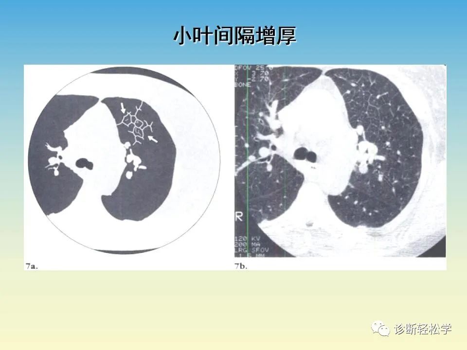 影像PPT - 【PPT】肺间质纤维化的影像表现-21