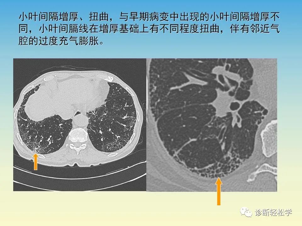 影像PPT - 【PPT】肺间质纤维化的影像表现-20
