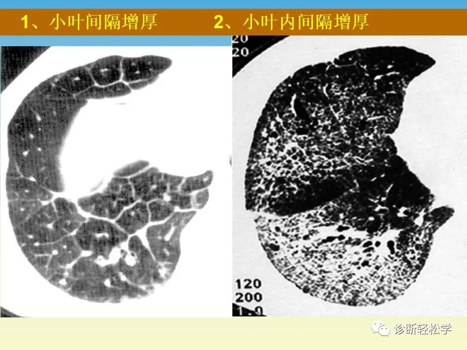 影像PPT - 【PPT】肺间质纤维化的影像表现-22