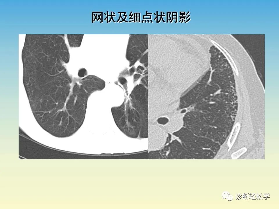 影像PPT - 【PPT】肺间质纤维化的影像表现-24