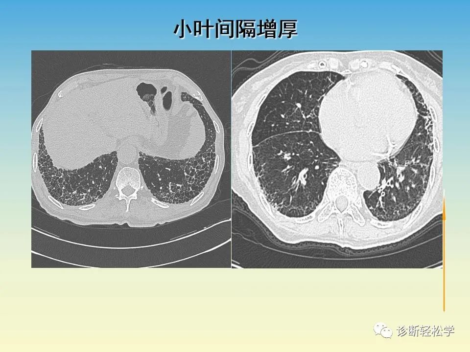 影像PPT - 【PPT】肺间质纤维化的影像表现-23