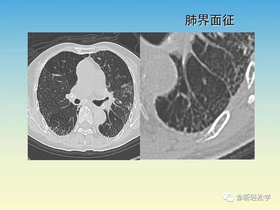 影像PPT - 【PPT】肺间质纤维化的影像表现-27