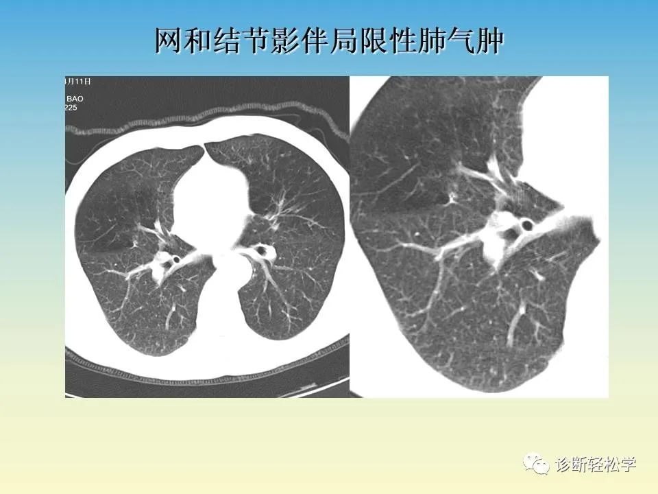 影像PPT - 【PPT】肺间质纤维化的影像表现-26