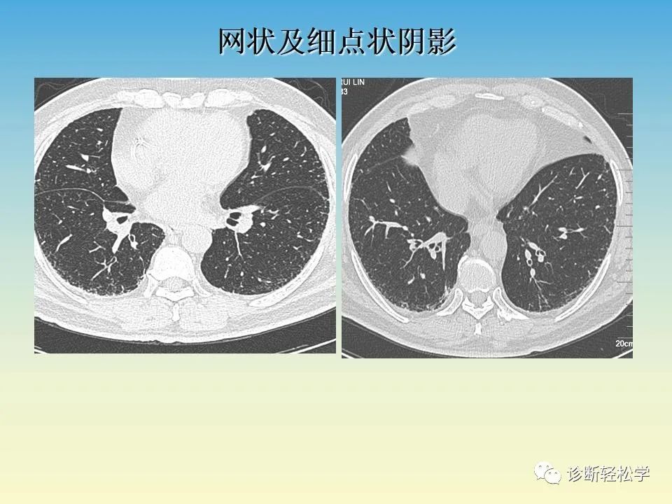 影像PPT - 【PPT】肺间质纤维化的影像表现-25