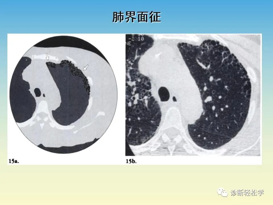 影像PPT - 【PPT】肺间质纤维化的影像表现-28