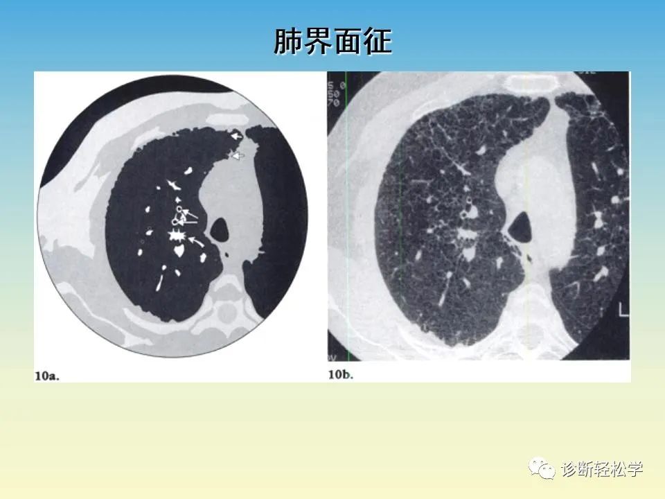 影像PPT - 【PPT】肺间质纤维化的影像表现-29