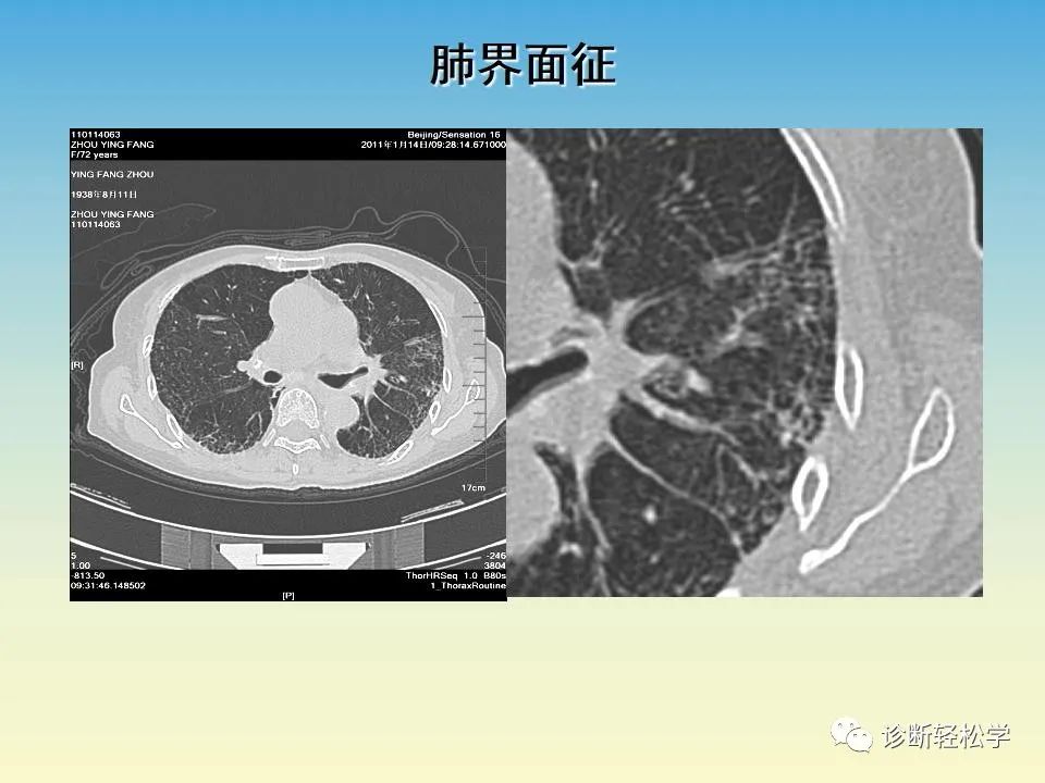 影像PPT - 【PPT】肺间质纤维化的影像表现-30