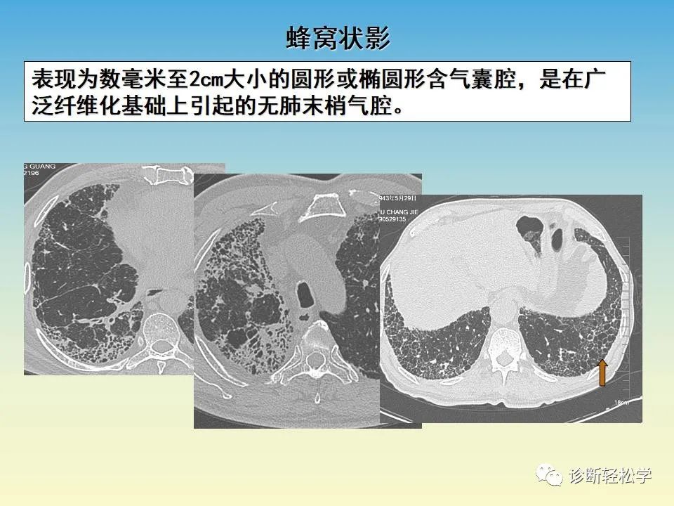 影像PPT - 【PPT】肺间质纤维化的影像表现-31