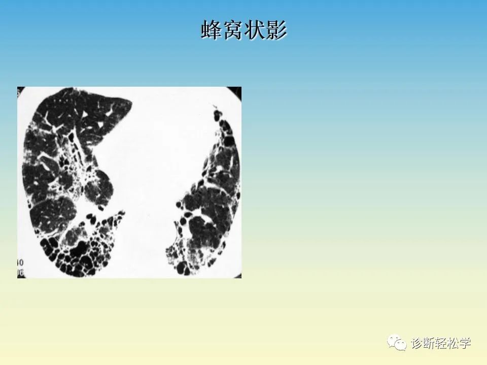 影像PPT - 【PPT】肺间质纤维化的影像表现-32