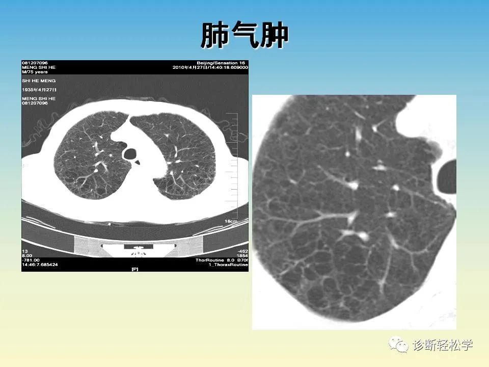 影像PPT - 【PPT】肺间质纤维化的影像表现-33