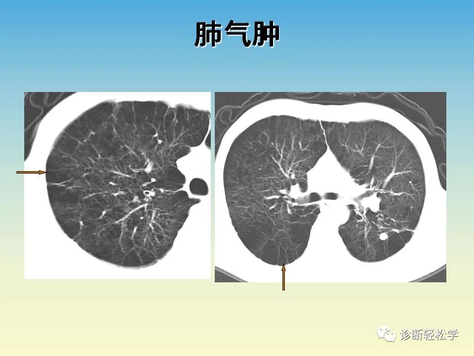 影像PPT - 【PPT】肺间质纤维化的影像表现-35