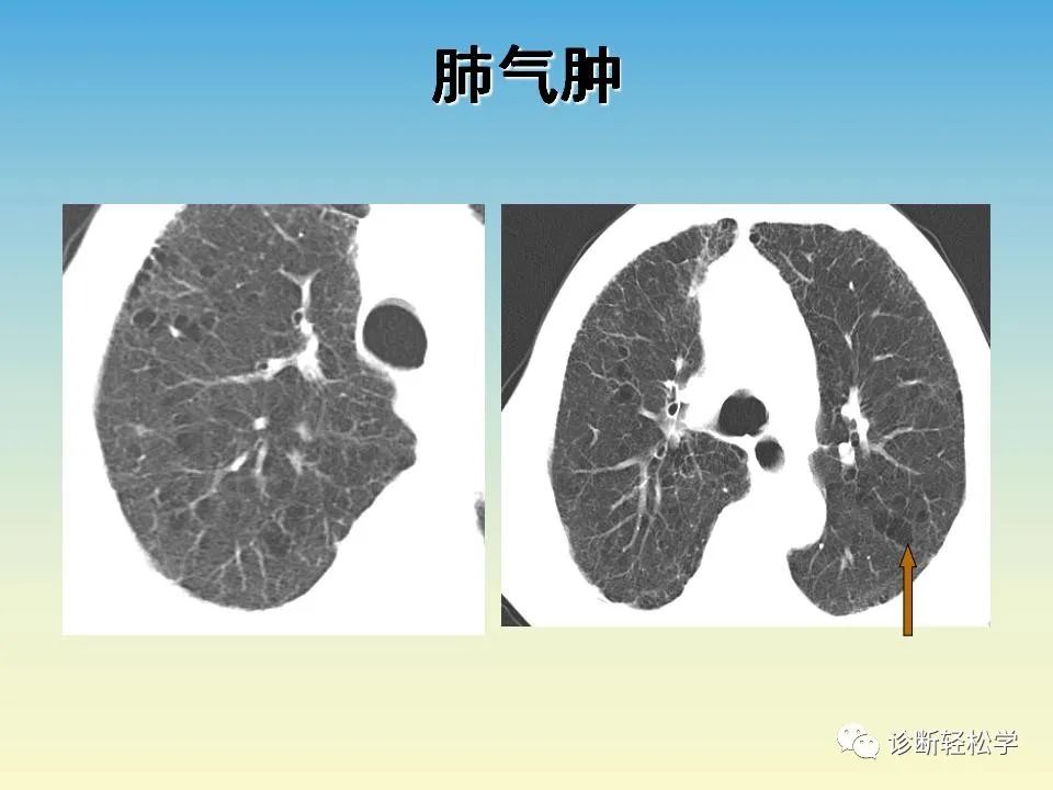 影像PPT - 【PPT】肺间质纤维化的影像表现-34