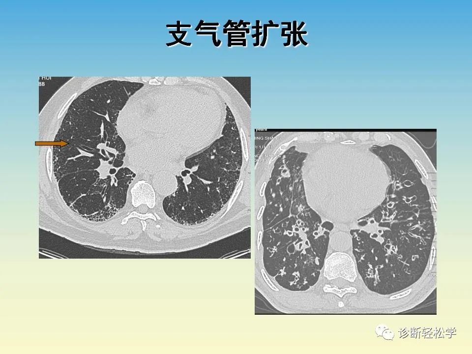 影像PPT - 【PPT】肺间质纤维化的影像表现-36