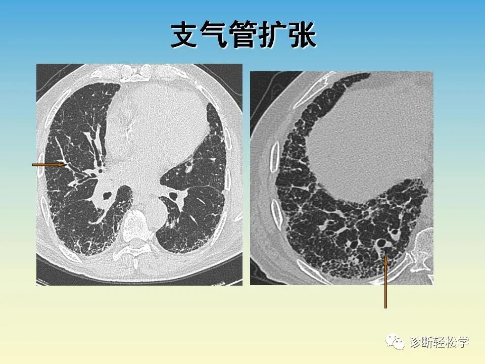 影像PPT - 【PPT】肺间质纤维化的影像表现-37