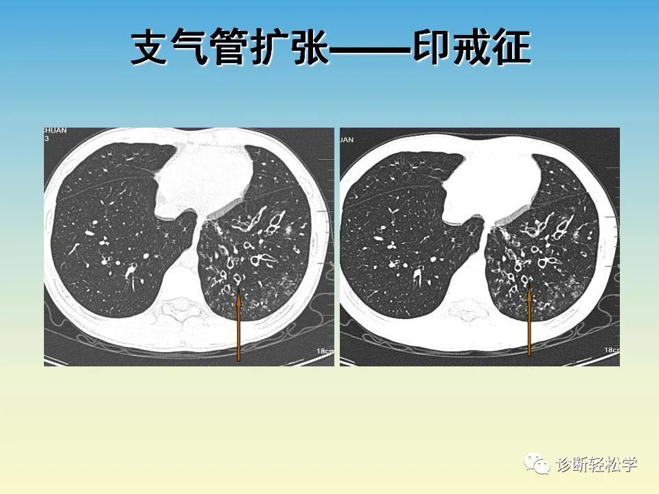 影像PPT - 【PPT】肺间质纤维化的影像表现-38