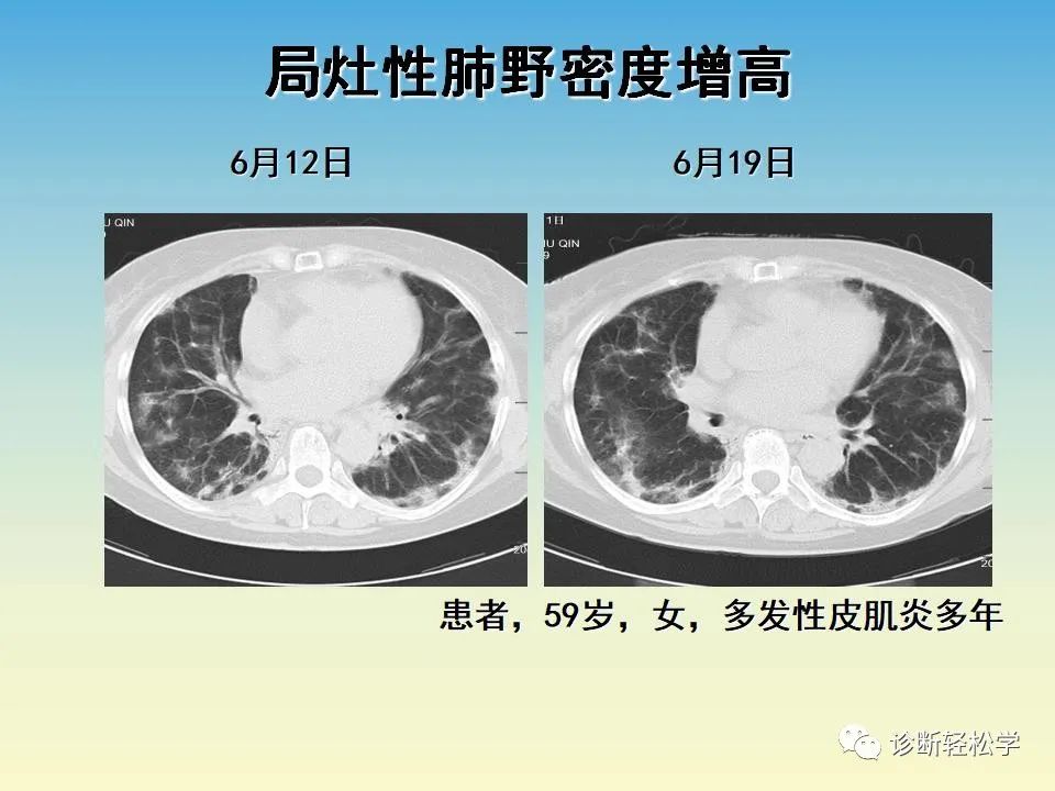 影像PPT - 【PPT】肺间质纤维化的影像表现-39