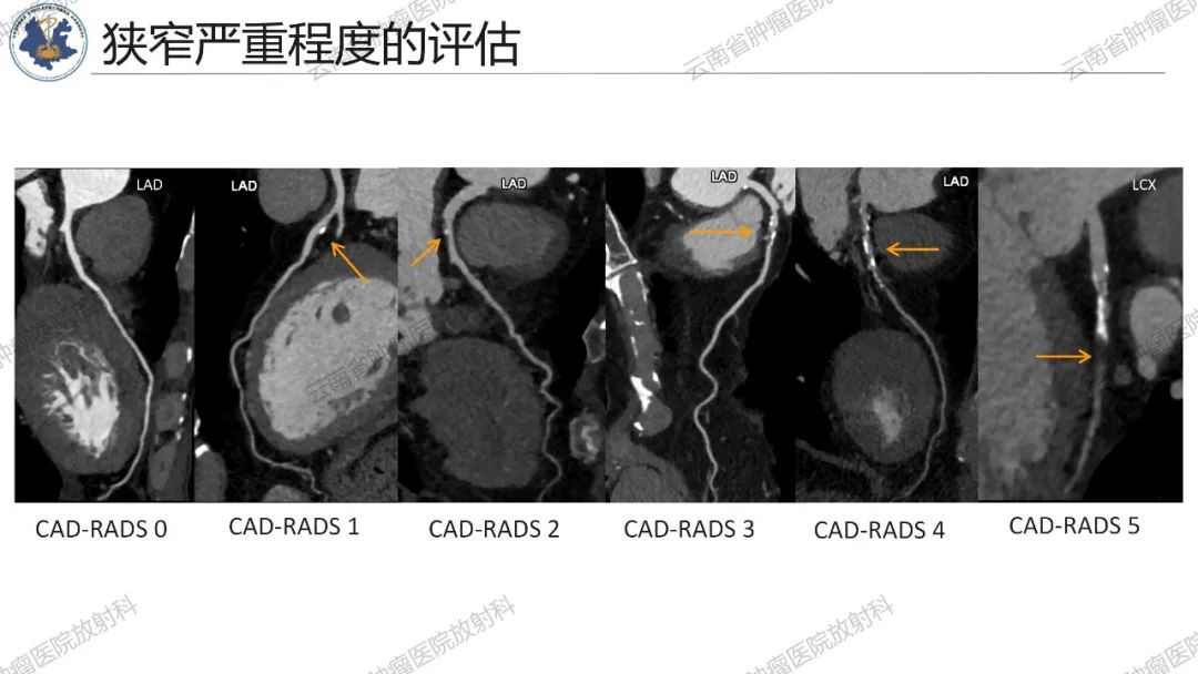 影像PPT - 【PPT】冠状动脉CTA报告规范化及后处理要求-15