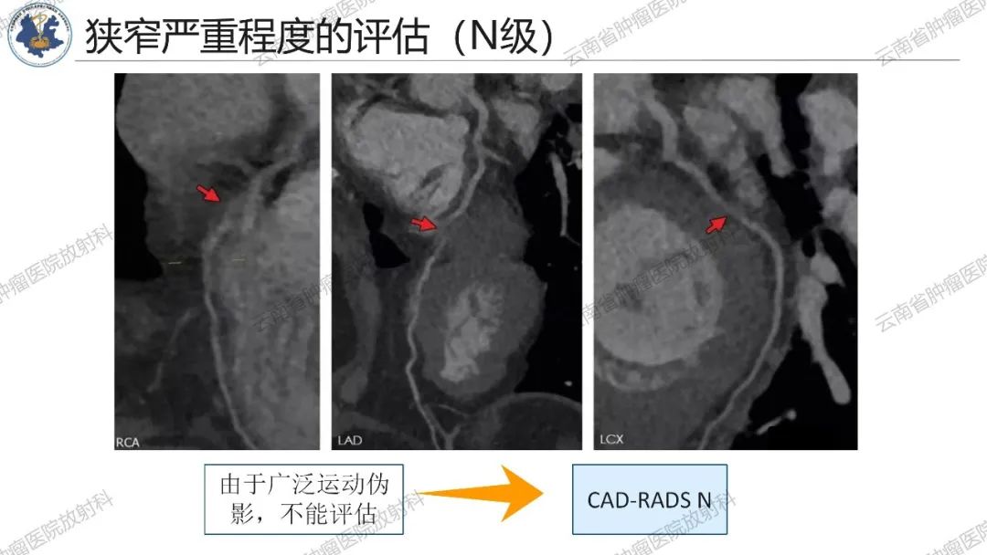 影像PPT - 【PPT】冠状动脉CTA报告规范化及后处理要求-16