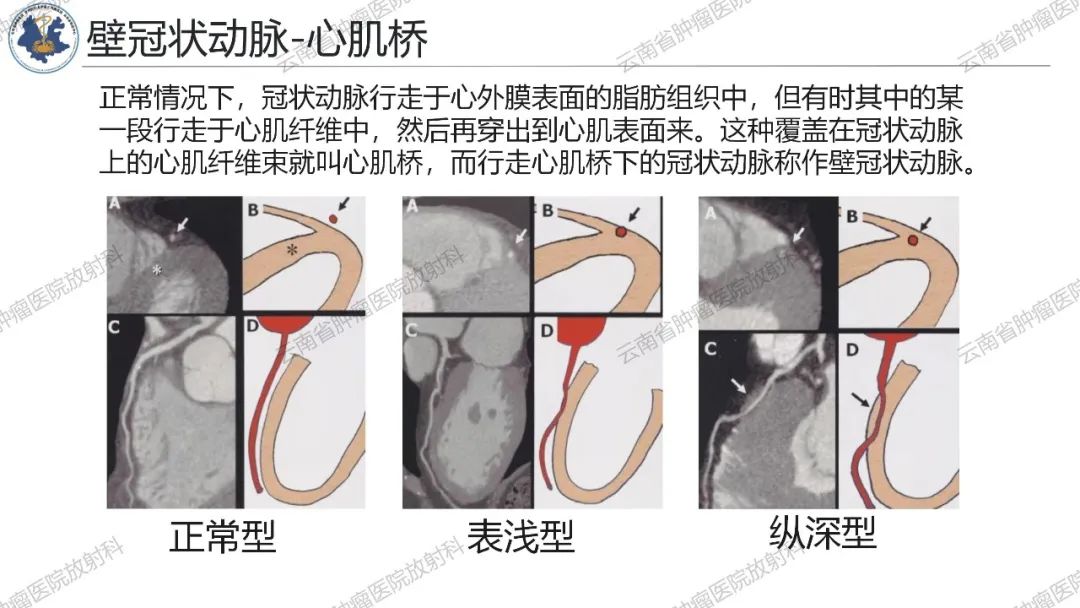 影像PPT - 【PPT】冠状动脉CTA报告规范化及后处理要求-30