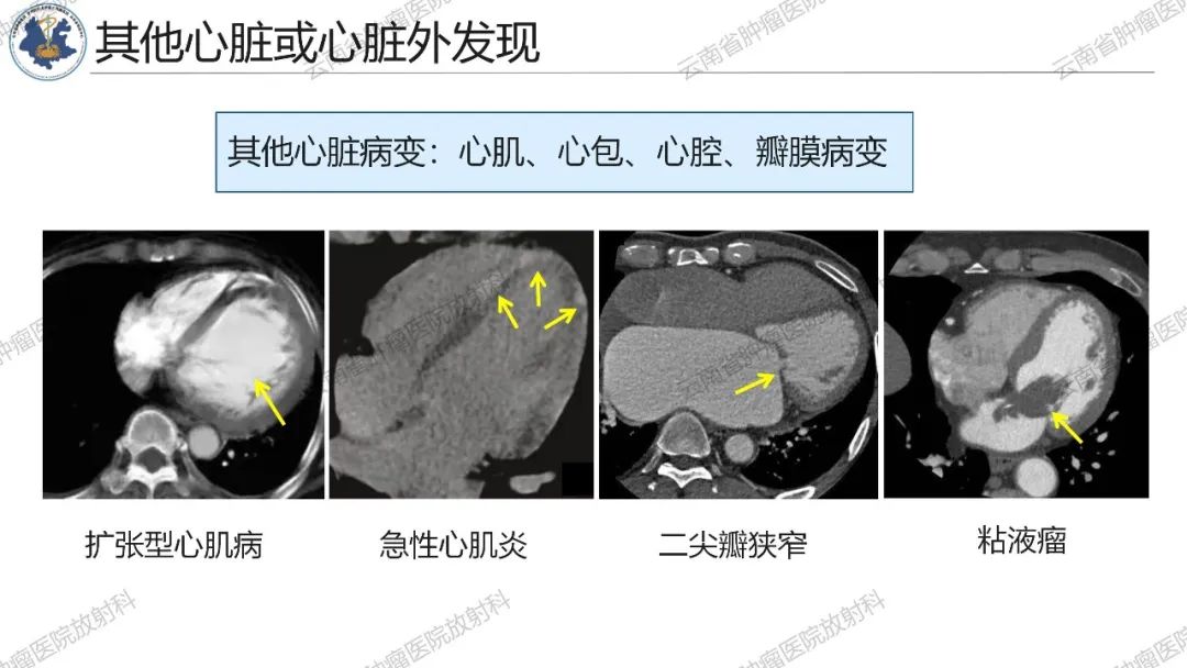 影像PPT - 【PPT】冠状动脉CTA报告规范化及后处理要求-33