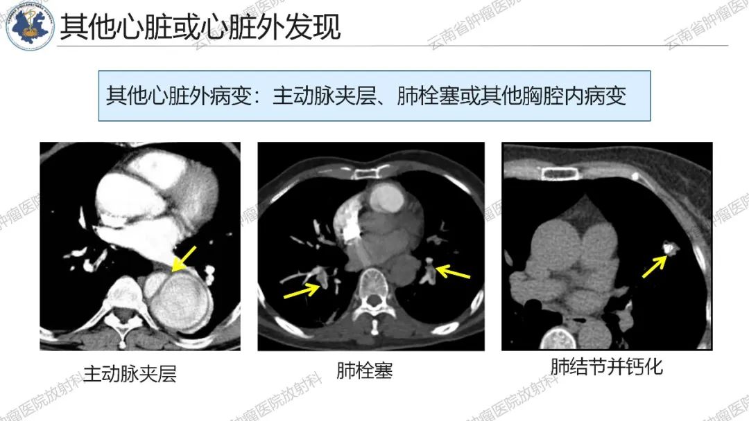 影像PPT - 【PPT】冠状动脉CTA报告规范化及后处理要求-34