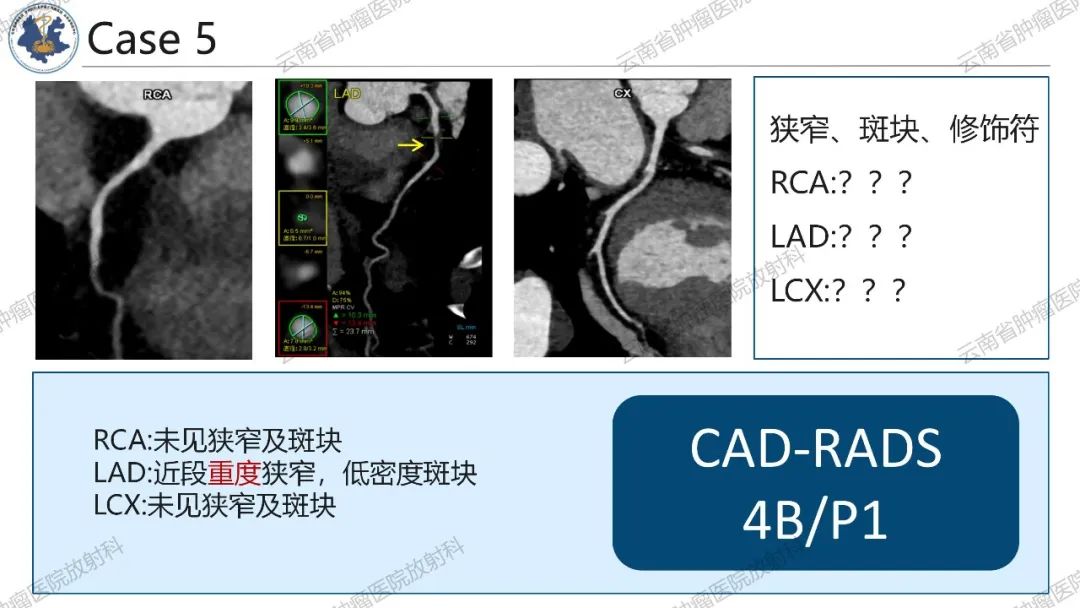 影像PPT - 【PPT】冠状动脉CTA报告规范化及后处理要求-46