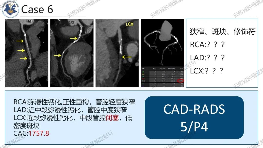 影像PPT - 【PPT】冠状动脉CTA报告规范化及后处理要求-47