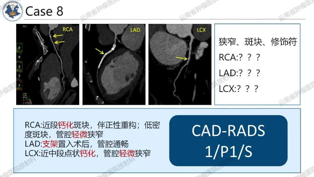 影像PPT - 【PPT】冠状动脉CTA报告规范化及后处理要求-49