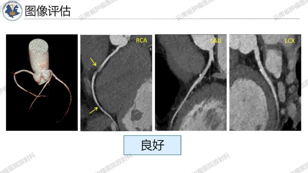 影像PPT - 【PPT】冠状动脉CTA报告规范化及后处理要求-55