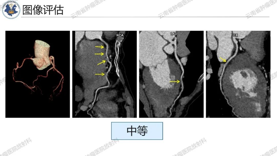 影像PPT - 【PPT】冠状动脉CTA报告规范化及后处理要求-56