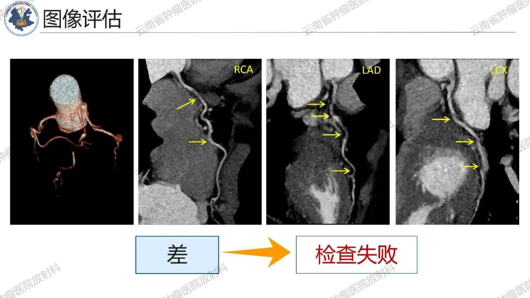 影像PPT - 【PPT】冠状动脉CTA报告规范化及后处理要求-57