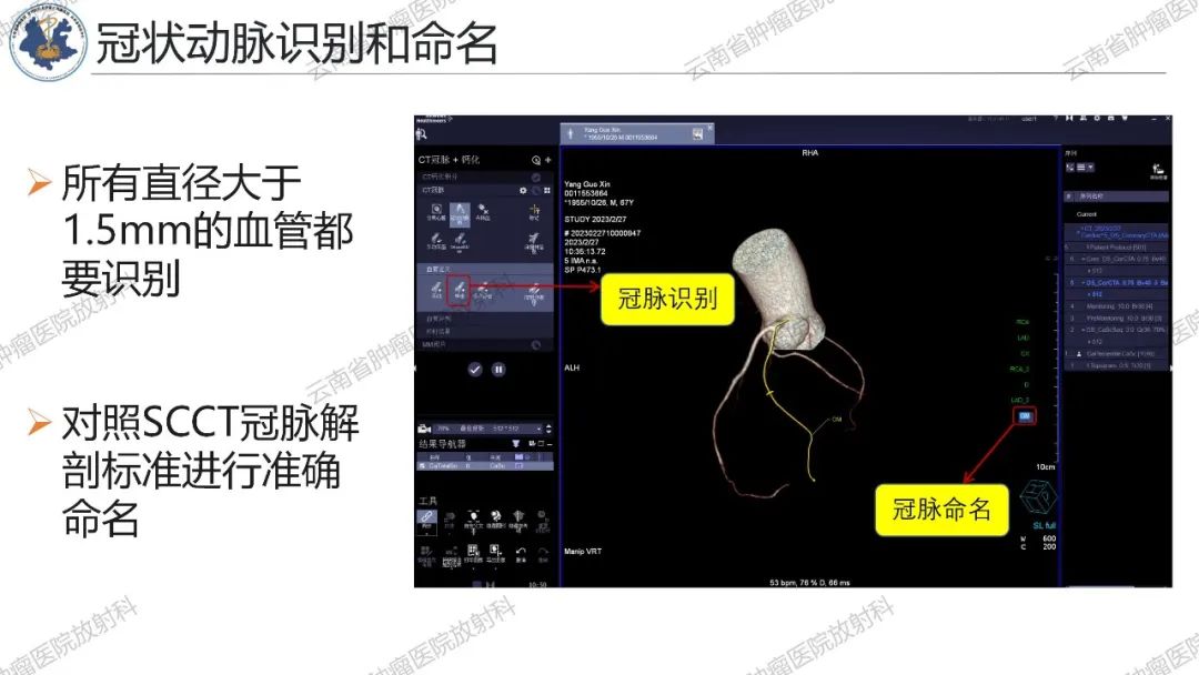 影像PPT - 【PPT】冠状动脉CTA报告规范化及后处理要求-58