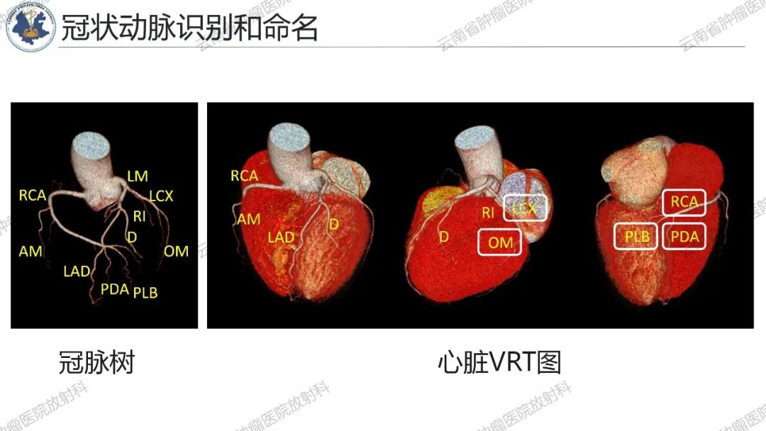 影像PPT - 【PPT】冠状动脉CTA报告规范化及后处理要求-59