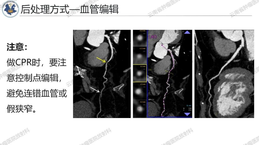 影像PPT - 【PPT】冠状动脉CTA报告规范化及后处理要求-61