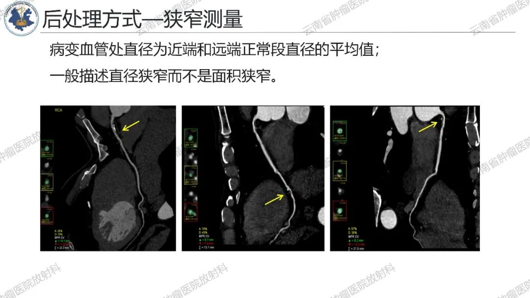 影像PPT - 【PPT】冠状动脉CTA报告规范化及后处理要求-62
