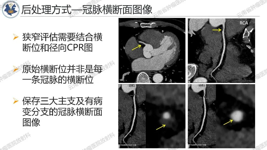 影像PPT - 【PPT】冠状动脉CTA报告规范化及后处理要求-63