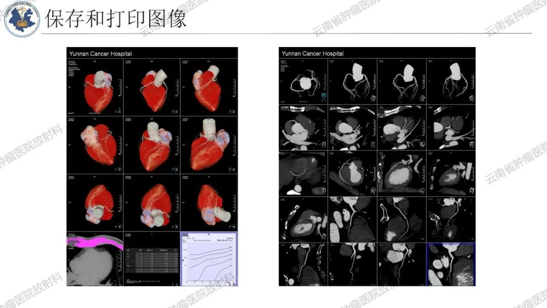 影像PPT - 【PPT】冠状动脉CTA报告规范化及后处理要求-66