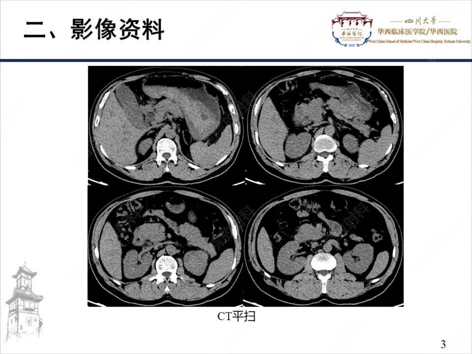 影像PPT - 【病例】自身免疫性胰腺炎1例CT影像诊断-3