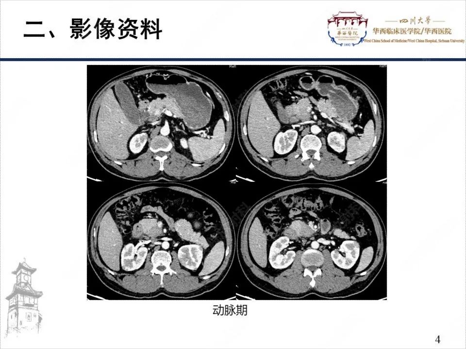影像PPT - 【病例】自身免疫性胰腺炎1例CT影像诊断-4