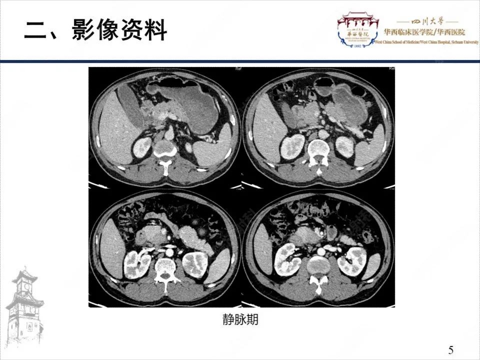 影像PPT - 【病例】自身免疫性胰腺炎1例CT影像诊断-5